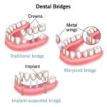 Ceramic Crowns and Bridges Fixing