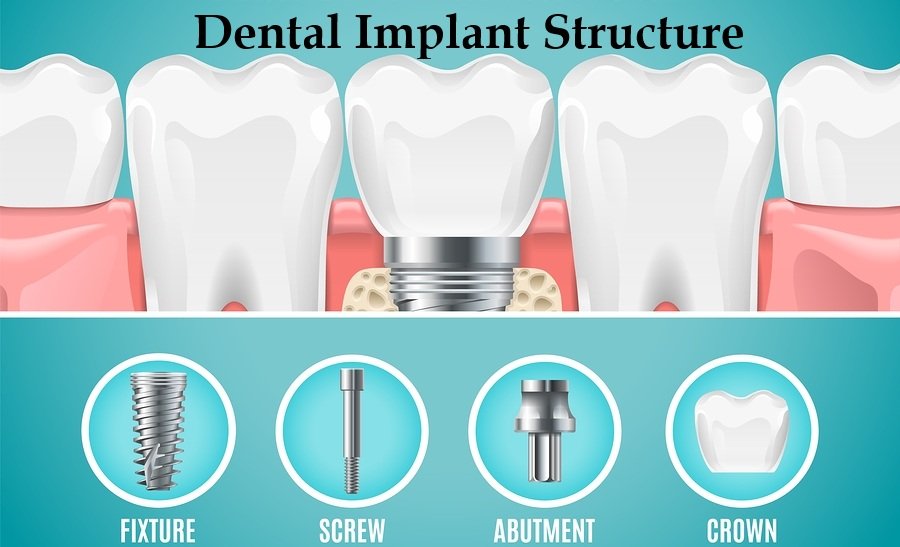 Dental Implant Structure. Vector Reallistic Tooth Implant Cut. D